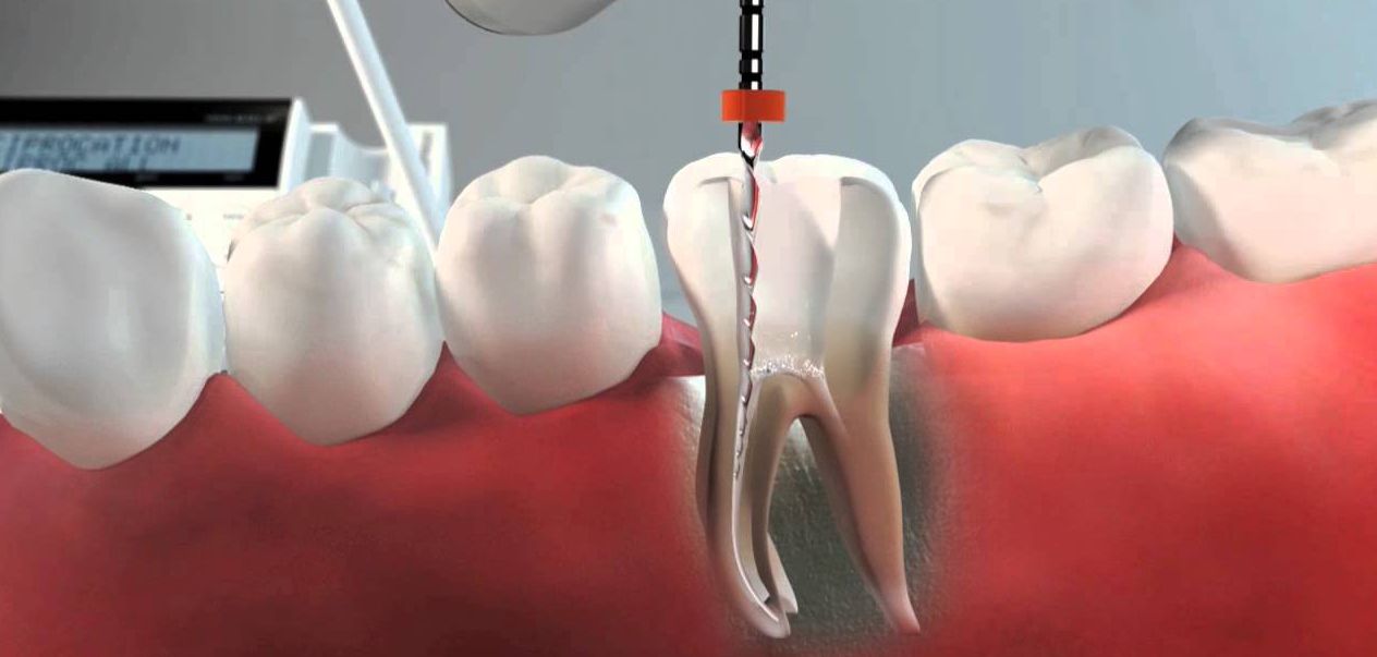Endodoncia Clinica Dental Oralvant Ibague Colombia