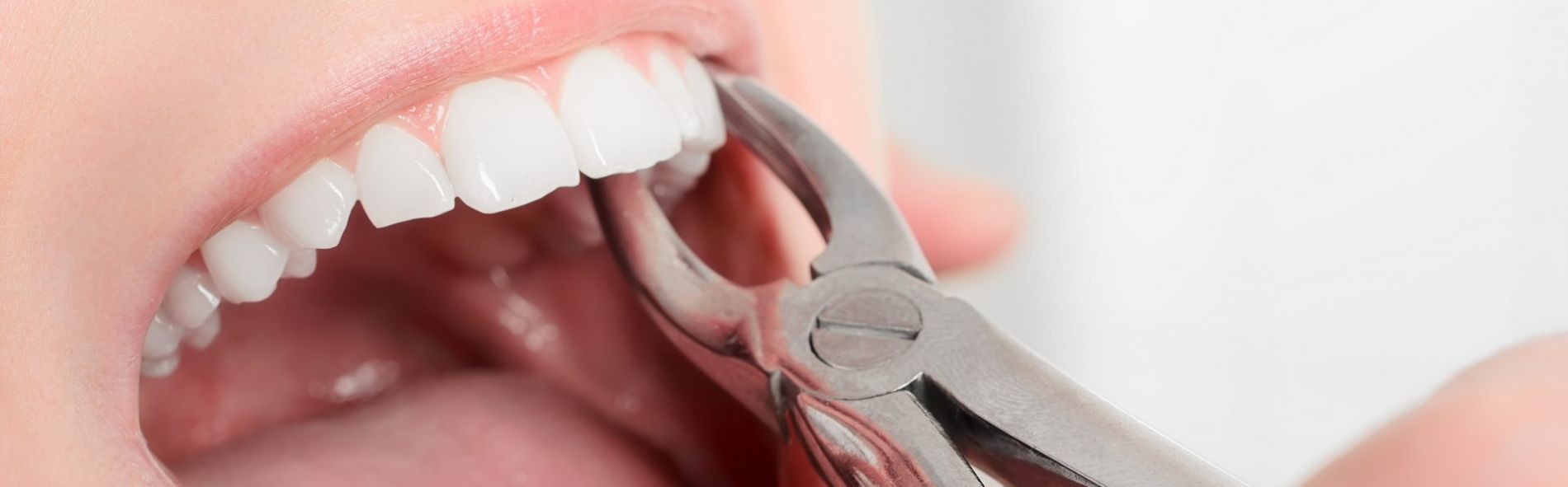 Exodoncia Clinica Dental Oralvant Ibague Colombia
