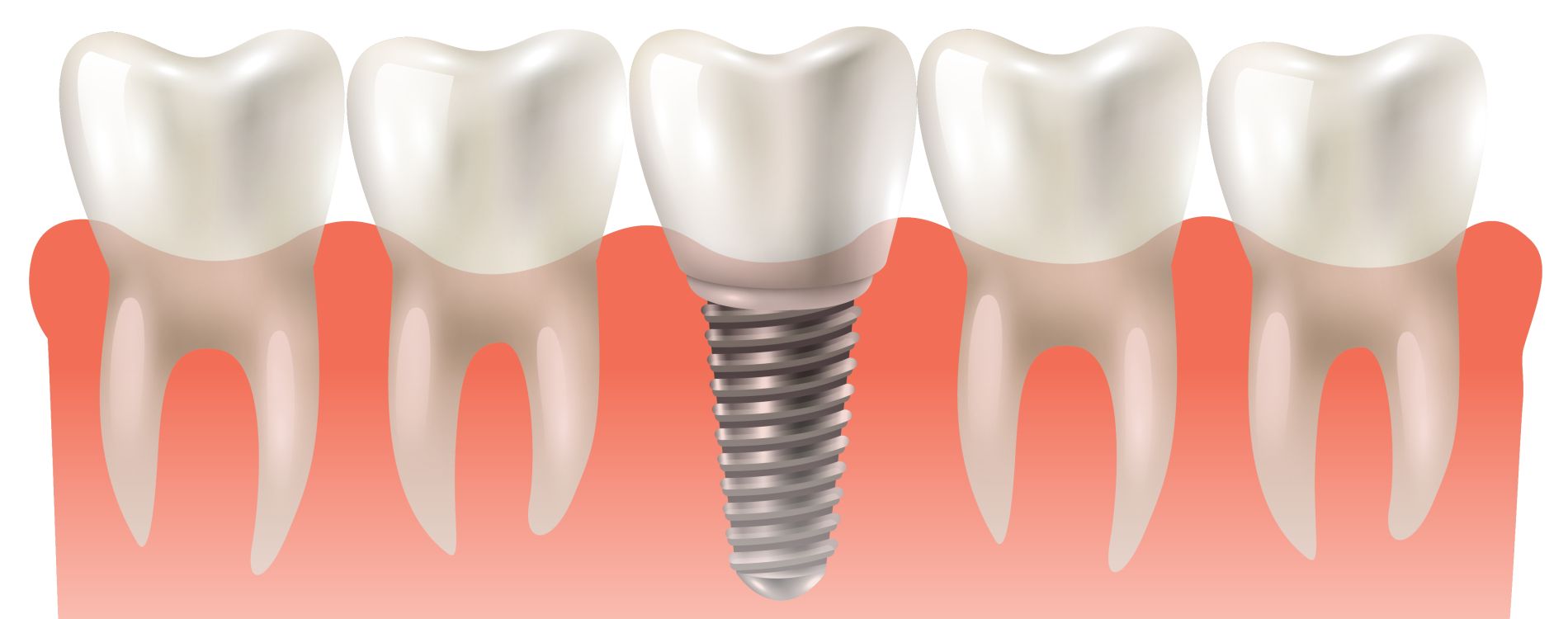Implantes Dentales Clinica Dental Oralvant Ibague Colombia