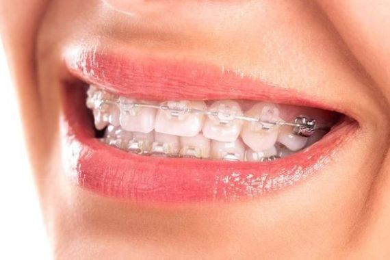 BRACKETS ESTÉTICOS O TRANSPARENTES Clinica Dental Oralvant Ibague Colombia